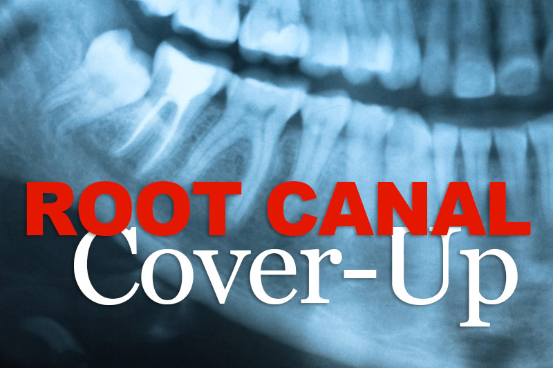 Root Canal Cover-Up